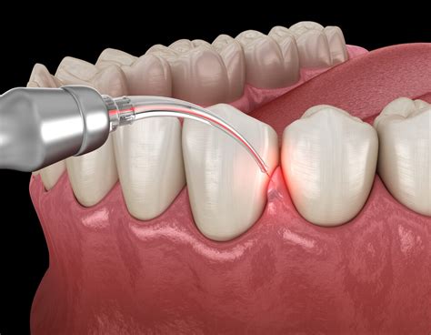 Gum Surgery | PerioNW | Burlington, WA