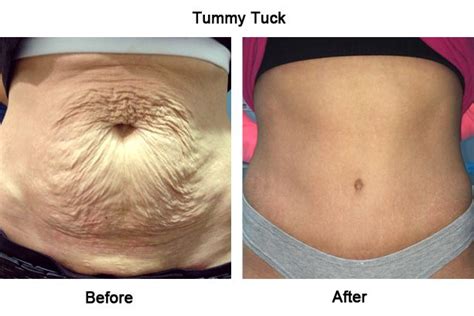 mini tummy tuck during c section - samarabouie