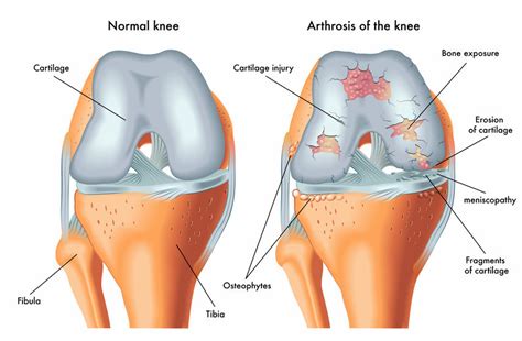 Rehab Exercises For Knee Cartilage Damage - Infoupdate.org