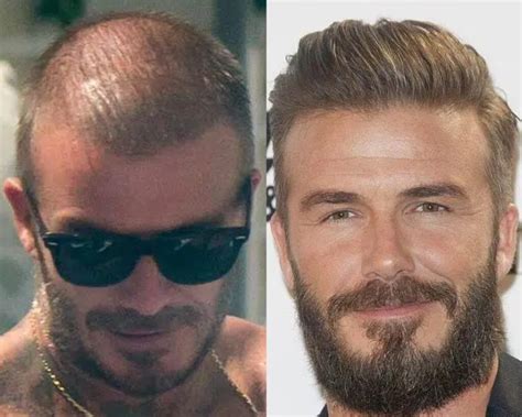 David Beckham Hair Transplant: See How He Transformed His Look!