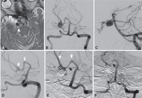 40 Posterior Cerebral Artery Aneurysms | Neupsy Key