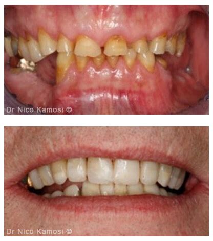 Full Mouth Rehabilitation Case Studies - London Specialist Dentists