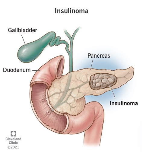 Insulinoma: Definition, Symptoms, Diagnosis & Treatment