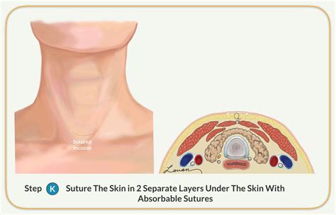 Parathyroidectomy - Parathyroid Gland Removal Surgery | Dr. Larian