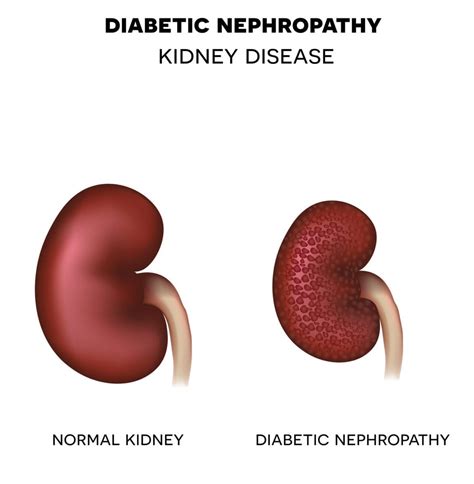 Nefropatía diabética - familydoctor.org