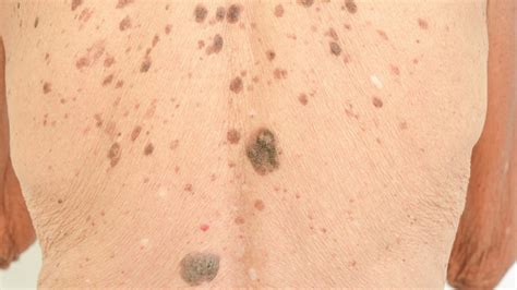 What Are Liver Spots On Skin