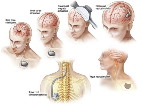 Global Neuromodulation Devices Market $33.5 Billion by 2031