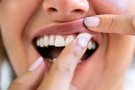 Snus and Your Teeth: Understanding the Damaging Effects - Crave Magazine