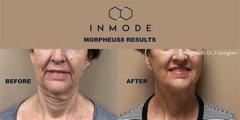 What is Morpheus8 Treatment? | Wave Plastic Surgery