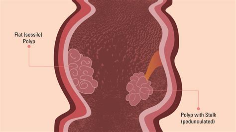 Types of Colon Polyps: Colon Polyp Symptoms and Risk Factors