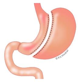 Sleeve Gastrectomy - Taylor Bariatric Institute