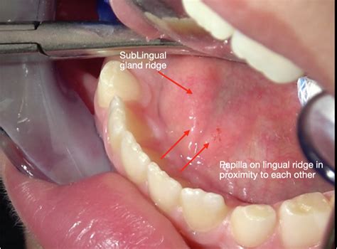 Topographic Positions of the Wharton's Duct Orifice in Children - Journal of Oral and ...