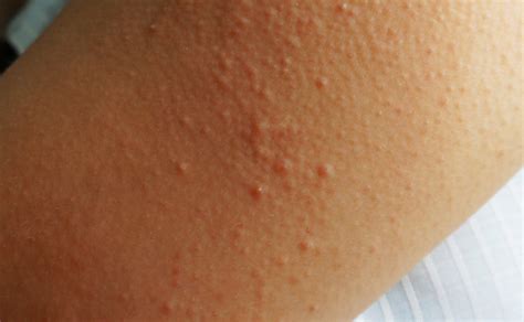 Red Bumps On Skin Keratosis Pilaris How To Get Rid Of - vrogue.co
