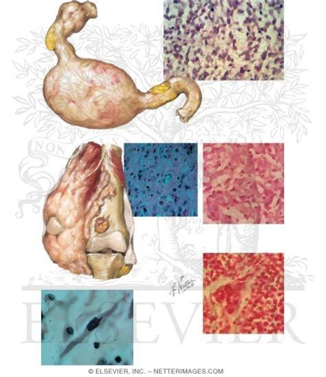 Neurosarcoma, Myosarcoma, Angiosarcoma