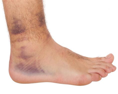 How Should I Treat a Sprain? (with pictures)