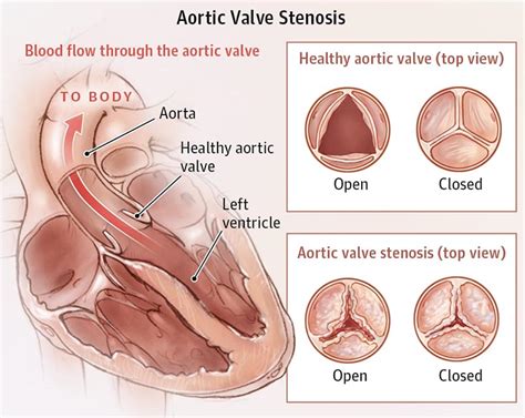 What is Aortic Stenosis - The Heart & Vascular Centre