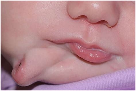 Baby Girl Born with Two Mouths in US Gets Duplicate Oral Cavity Removed ...