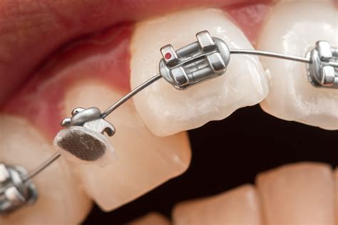 What To Do If You Have Broken Braces | Ahava Orthodontics