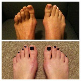 My mom's feet and mine before and at 4 months after our double bunionectomy. http ...
