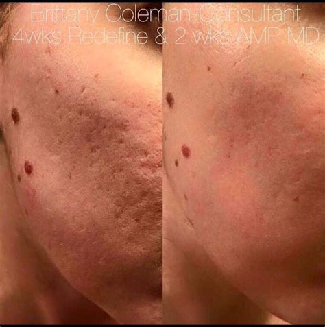 Acne Scars Before And After Retinol | Before And After