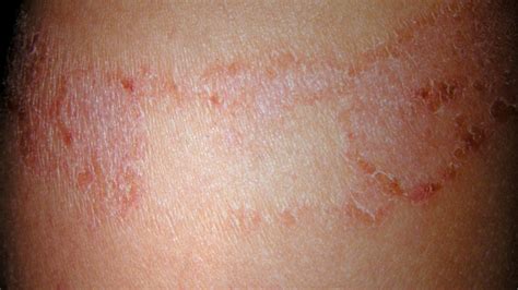 Lesioni Cutanee Immagini Cause Tipi Rischi Diagnosi E Trattamenti | My XXX Hot Girl