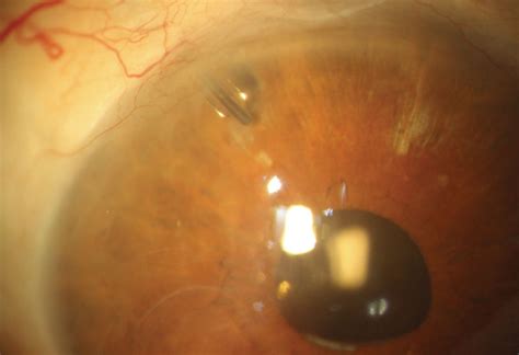 Tube Shunt Maintains IOP at 10 Years in 50% of Patients