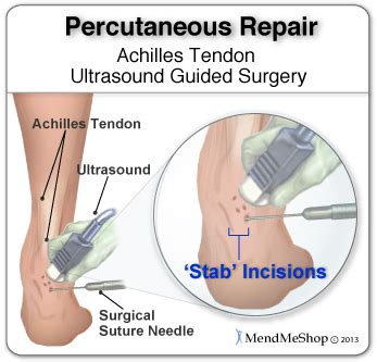 Post Surgery Rehabilitation - Achilles Tendonitis