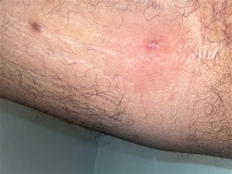 ingrown hair or cyst? inner thigh/groin : r/DermatologyQuestions