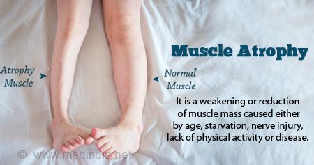 Health Tip on Muscle Atrophy - Health Tips