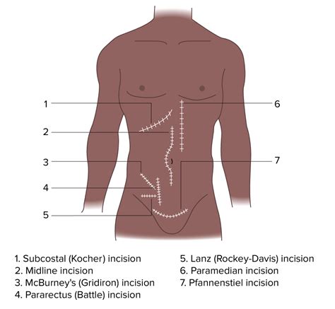 Rocky Davis Incision