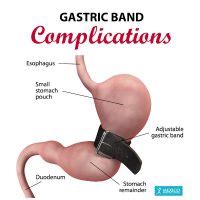 Gastric Banding (Lap-Band) Surgery Risks, Complications