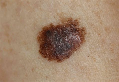 Melanoma On Arm