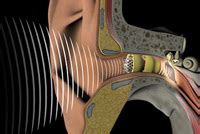 Phonak Shrinks Lyric Invisible Hearing Aid And Improves Fit To Increase The Number Who Can Use ...