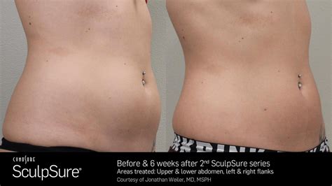 Laser Body Contouring - Before and After | SculpSure