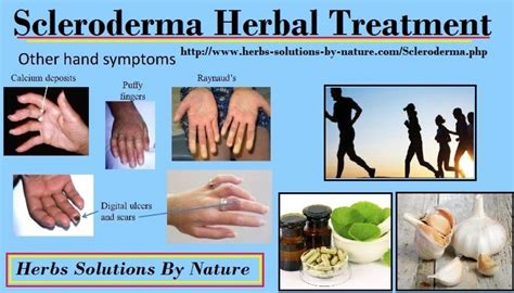 Scleroderma Herbal Treatment with Herbal Supplement