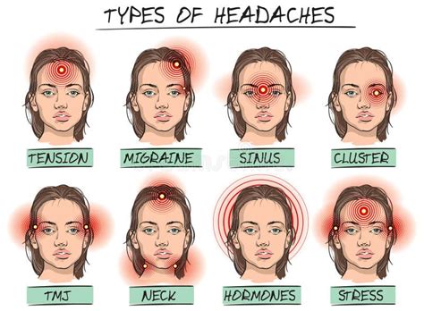 Headache Types Outline Icons Set - Various Symbols of Human Head with Different Pain. Stock ...