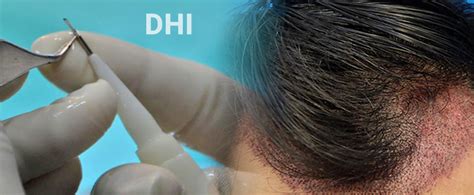 DHI Hair Transplant in Turkey - Choi Pen Hair Restoration - U-Fue