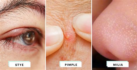 Eyelid Bump Symptoms Causes And Treatments - vrogue.co