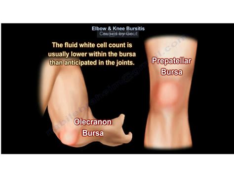 Gout Elbow Bursitis