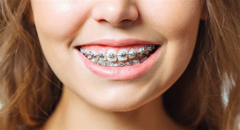 What Are Ceramic Braces Smile Solutions Article | My XXX Hot Girl