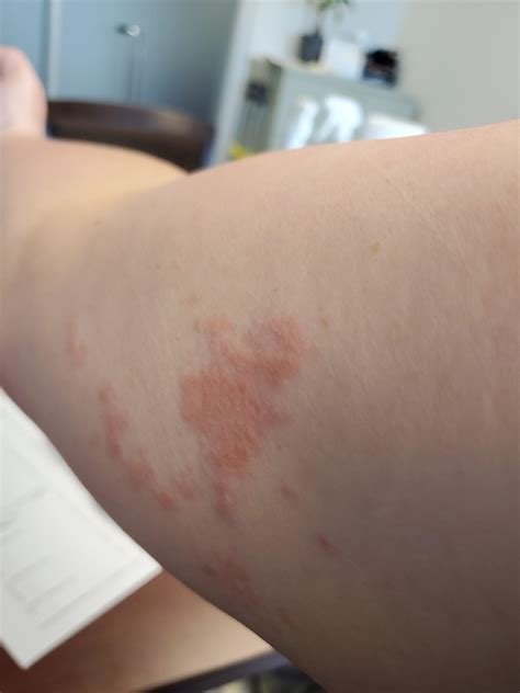 Do you get rashes like this? I've got a rheumatologist appointment next week. No diagnosis yet ...