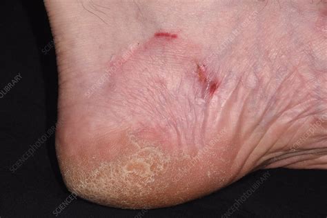 Ringworm on the foot - Stock Image - C051/1228 - Science Photo Library