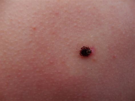 What Do Ticks Look Like On Human Skin Kwhatdo | Images and Photos finder