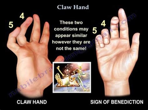 Claw Hand, Ulnar Claw Hand - Everything You Need To Know - Dr. Nabil ...