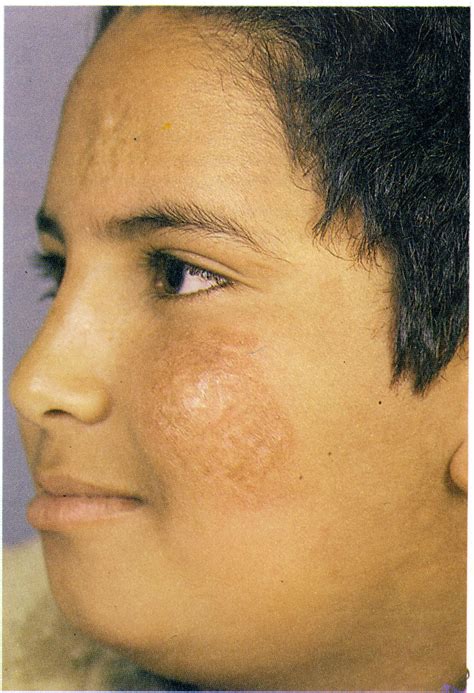 Mucocutaneous Leishmaniasis