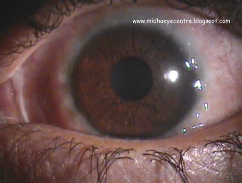 Take Care Of Your Eyes: Vernal Keratoconjunctivitis