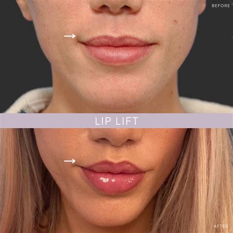 Lip Lift NYC | Lip Specialist New York