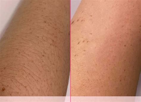 IPL Hair Removal: What To Expect Before And After | RoseSkinCo.