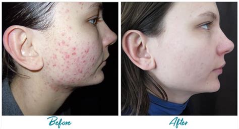 Acne Scar Treatments PHX | Acne Suddenly Slimmer Med Spa Phoenix