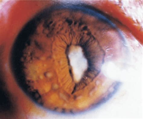 The anterior segment manifestations of a 43-year-old male VKH patient ...